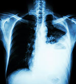 X-ray of a person's chest with lung cancer X-ray of a person's chest with lung cancer